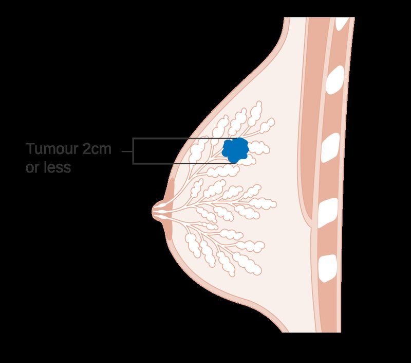 Breast cancer surgery consultation — Dr. Amit R. Gandhi, Mumbai