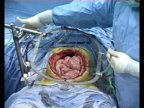 Open abdominal cytoreductive surgery with HIPEC set-up for peritoneal cancer