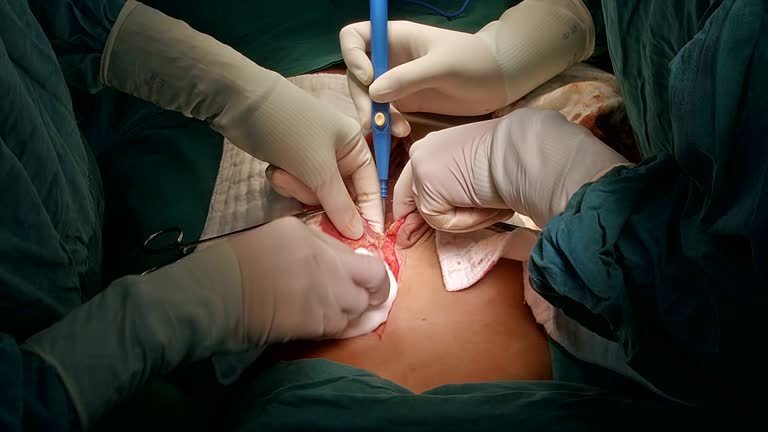 Exploratory laparotomy — open abdominal surgery to see how far a cancer has spread, performed by Dr. Amit R. Gandhi