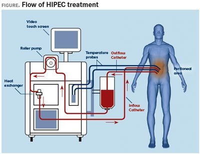 Diagram of HIPEC treatment flow: heated chemotherapy pumped through a heat exchanger into the abdomen and back — Dr. Amit R. Gandhi, HIPEC surgeon Mumbai