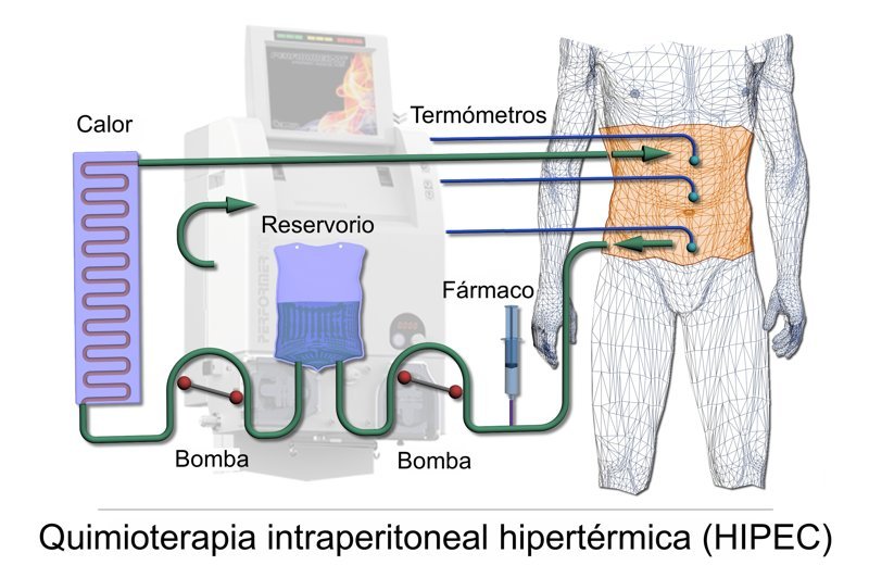 HIPEC surgery and peritoneal cancer treatment — Dr. Amit R. Gandhi, HIPEC surgeon Mumbai