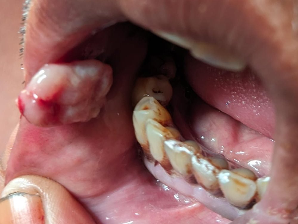 Oral cancer — a growth inside the mouth (oral cavity); a biopsy confirms the diagnosis before treatment at Cansure Centre, Mumbai