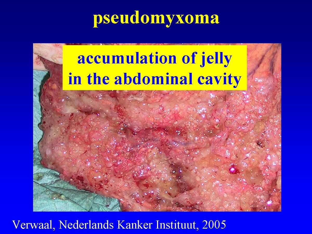 Pseudomyxoma peritonei — mucinous jelly-like tumour spread across the abdominal cavity, treated with cytoreductive surgery and HIPEC